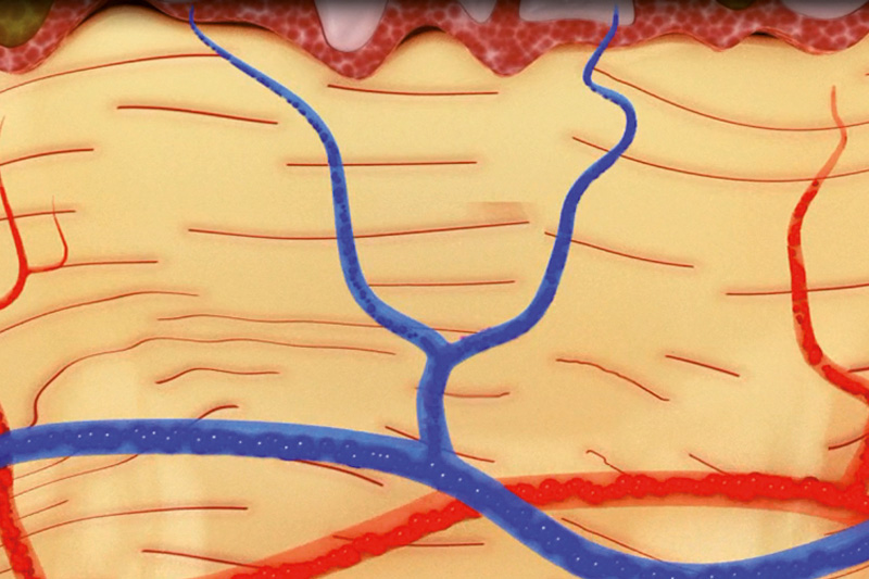 Schaubild: Detailansicht der Blutgefäße unter der Haut