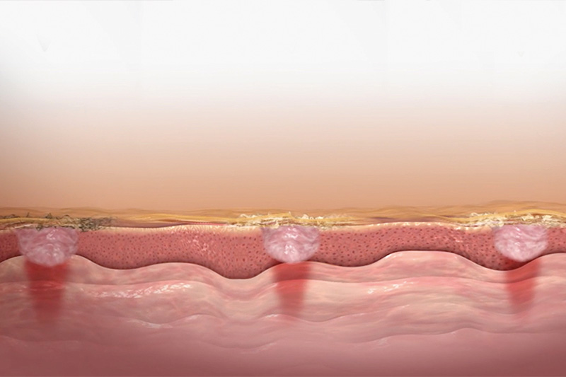 Wirkungsweise des Mezotix®-Verfahrens: Offene Mikroporen nach dem Hautkontakt